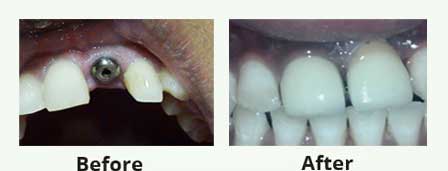 implants service